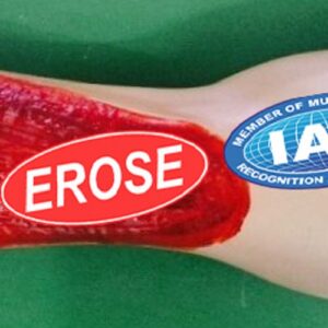 Electric Burn In Arm, Forensic Model