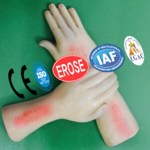 Scabies, Forensic Model