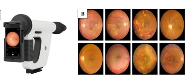 Fundus Camera, Hand Held