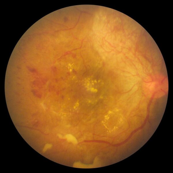 Hand Held, Fundus Camera